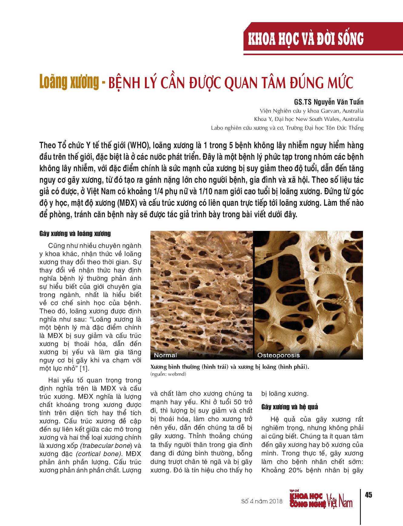 Loãng xương - Bệnh lý cần được quan tâm đúng mức