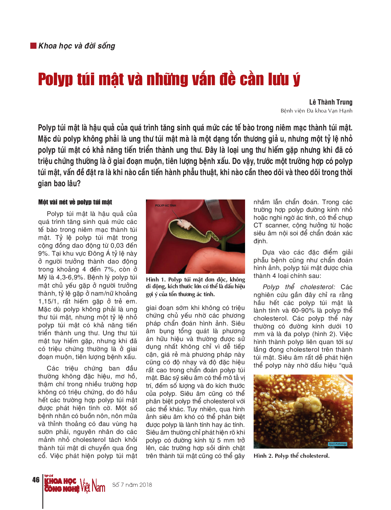 Polyp túi mật và những vấn đề cần lưu ý